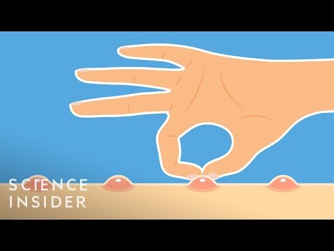 Why You Shouldn't Pop Your Pimples | Science Insider